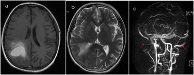 Case Report: A successful outcome of nadroparin calcium therapy for cerebral venous sinus thrombosis in a child with acute lymphoblastic leukemia